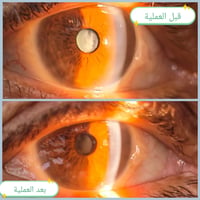 رفع الماء الأبيض • طبيب عيون • المسيب