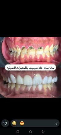 عيادة الزين • تبييض مجاني • بسماية