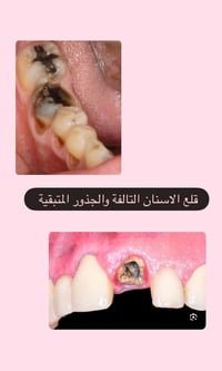 عيادة قلع • قلع جذور • الأربعاء 10 صباحاً