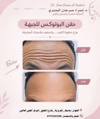 بوتوكس • أخصائية جلدية • واسط العزيزية