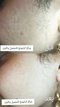 ليزر • بشرة صافية • الحود
