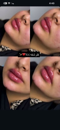 فلر شفه • 1cc • حجز