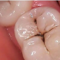 قلع أسنان • تنظيف أسنان • عيادات جامعة القادسية