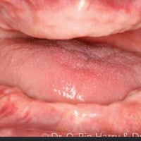 طقم متحرك • تعويض أسنان • البصرة
