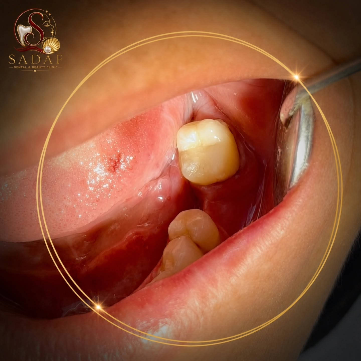 🦷✨ الابتسامة تبدأ من علاج أسنانك
لا تهمل التسوس أو الألم، فالعلاج المبكر يحافظ على أسنانك ويجنبك مضاعفات أكبر.
في صدف Dental & Beauty Clinic نهتم بصحة أسنانك ونمنحك العناية التي تستحقها 🤍
📍 صدف – عيادة الأسنان والتجميل
📩 للحجز والاستفسار تواصلوا معنا عبر الخاص

📍النجف _امتداد شارع الاسكان _مقابل سايدين المعلمين 
📞 ‭ *********** ‬
#النجف #العراق_السعودية_قطر_الامارات_الكويت_البحرين_اليمن_الخليج_سوريا_مصر_لبنان_الجزائر_تونس_المغرب_قطر_دبي #تجميل #اكسبلور_فولو⁩
