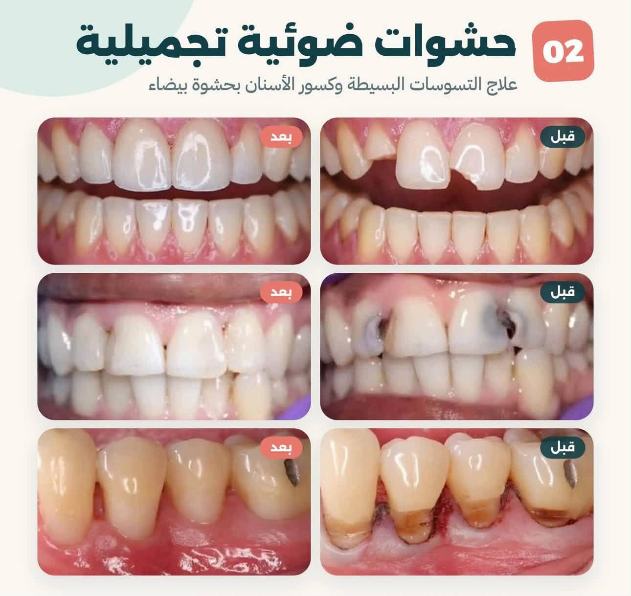 الكرادة جامعة اوروك • علاج مجاني • تنظيف الأسنان