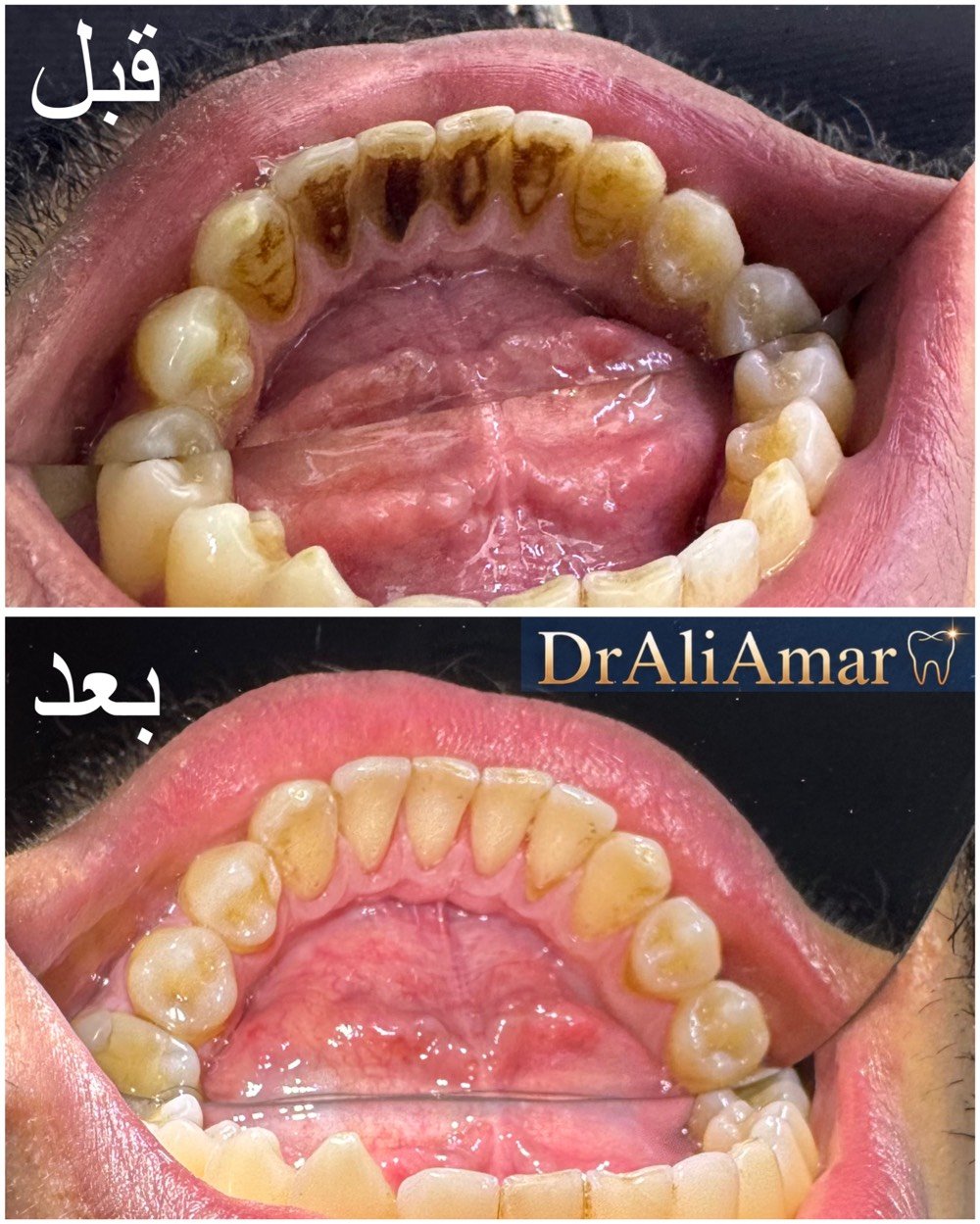 التنظيف لأول جلسة مجاني 🦷🤍
والذي يميزنا عن باقي العيادات نستقبل حالات الطوارئ لمدة 24 ساعة 
ورقم الطوارئ وللحجز والاستفسار : ***********
الموقع📍:الحسينية_الراشدية / مقابل الحاج الحسن ومجاور لمصور الزهور
#dentist #doctor #الحسينية #مطعم_الامير #طب_اسنان