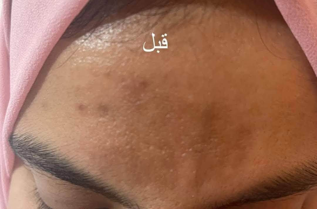 #بيبي_كلو  و  #الديرمابن 
الديرما بن ب 30 بدل ال75

البيبي كلو ب 75 بدل ال125 

تقنيه #البيبي_كلو 🥰🥰 Baby glow 

مواد بيبي كلو هي مواد طبيعيه تجميليه علاجيه مستحيييييل تسبب اَي ضرر للبشره لان كلها فيتامينات 
وهي بصوره عامه ماخذيها علاج تجميلي 

 #اول_جلسه تحسين اختفاء بعض التصبغات  وإغلاق المسامات وعلاج ل حب الشباب وغطت بعض العيوب لكن هي مو كريم أساس هي ماده علاجيه مخلوطة من ضمن

 مجموعه فيتامينات فتعطي نضاره للوجه وتفتح وتوحد لون البشره بنفس الوقت💥

وطبعا بحكم شغلها بطريقه أمنه جدا راح تشد البشره وتحفز الكولاجين والايلاستين... ♥️♥️♥️

ومتغلق مسامات الوجه بالعكس من تدخل داخل البشره راح تعالج بعض مشاكل البشره مواد أمنه جدا وطريقه أمنه جدا 
االنتيجه من اول جلسه واضحه💖
       للحجز والاستفسار مراسله الصفحه
***********
