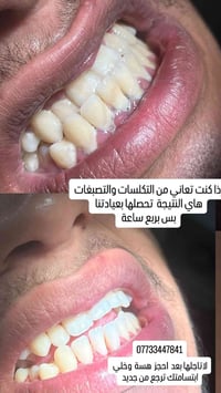تنظيف اسنان • ربع ساعة • الفحامة