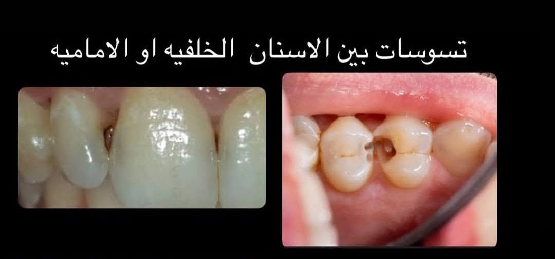 ( مجاني )

ديالى بعقوبة - جامعة اليرموك
الي عنده بقايا اسنان او اسنان تعبانة و تحتاج قلع يراسلني خاص او واتساب *********** نحجز موعد

العلاج مجاني و تحت إشراف اطباء اختصاص

الخدمات الى نقدمها :
_تنضيف اسنان وإزالة التصبغات و التكلسات
_حشوات ضوئية تجميلية وعلاجية
_تعویض اسنان مفقودة اسنان مفردة او كاملة 
_قلع اسنان او بقايا الجذور

نص مكتوب في الصور:
- قبل بعد تعويض الاسنان المفقودة بطقم جزئي او كامل متحرك BEFORE FLEXIBLE NYLON DENTURE AFTER
- تسوسات بين الاسنان الخلفيه او الاماميه