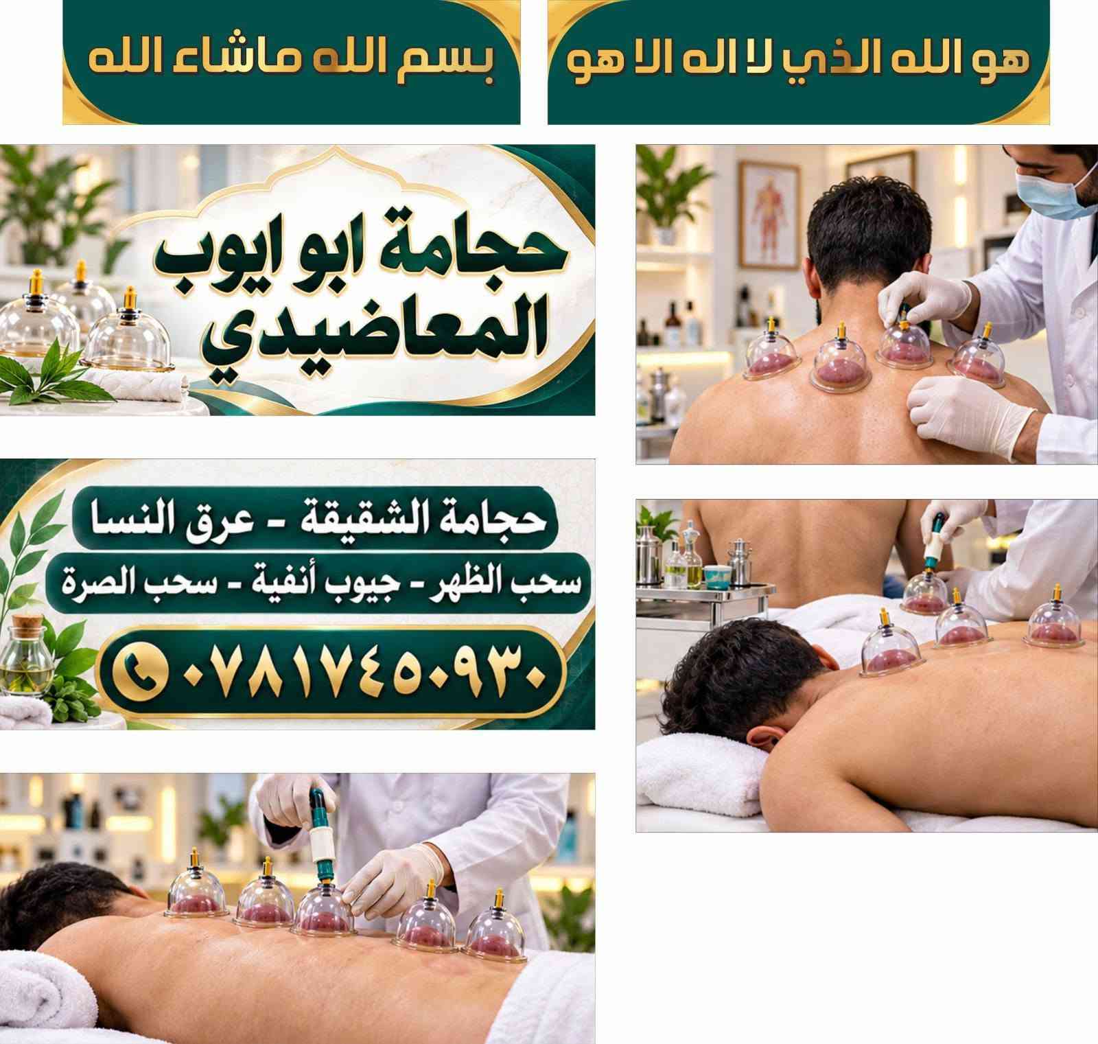 حجامة • الشقيقة • عرق النسا