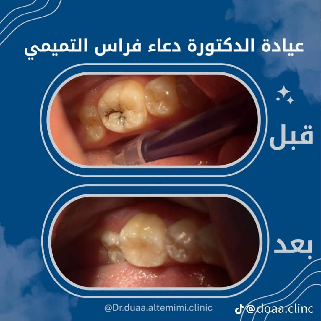 🦷عيادة الدكتورة دعاء فراس التميمي 🦷
-لعلاج الاسنان بالتقويم الشفاف والمعدني 

-زراعة الاسنان وعمل التراكيب السنية بالزاركون والسيراميك 

-عمل الحشوات التجميلية وحشوات الجذور 

-تنظيف وتبيض الاسنان بالليزر 

📍الكمالية - شارع الجامع  - مقابيل مثلجات الفريداوي 

🕠اوقات الدوام من الساعة 

4  مساءً الى الساعة  2 بعد منتصف الليل 

جميع ايام الاسبوع 

📞للحجز والاستفسار :

***********
