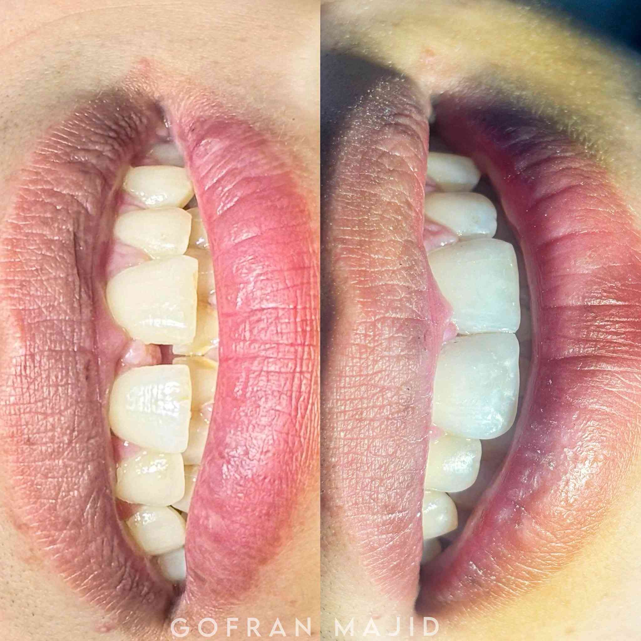حالة غلق الفراغات بين الاسنان بالحشوات التجميلية الضوئية 😍❤️‍🔥

DrGofran Majidالدكتورة غفران ماجد 

للحجز والاستفسار مراسلة الواتساب *********** 
📍الديوانية/سومر/مجاور سيد علي للاعشاب 

Direct composite restoration for closing the distema 
Case created by dr. Gofran majid
Composite by tokuyama 

@إشارة

نص مكتوب في الصور:
- GOFRANMAJID
- GOFRAN MAJID