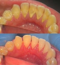 تنظيف اسنان • حشوات تجميلية • مجاني