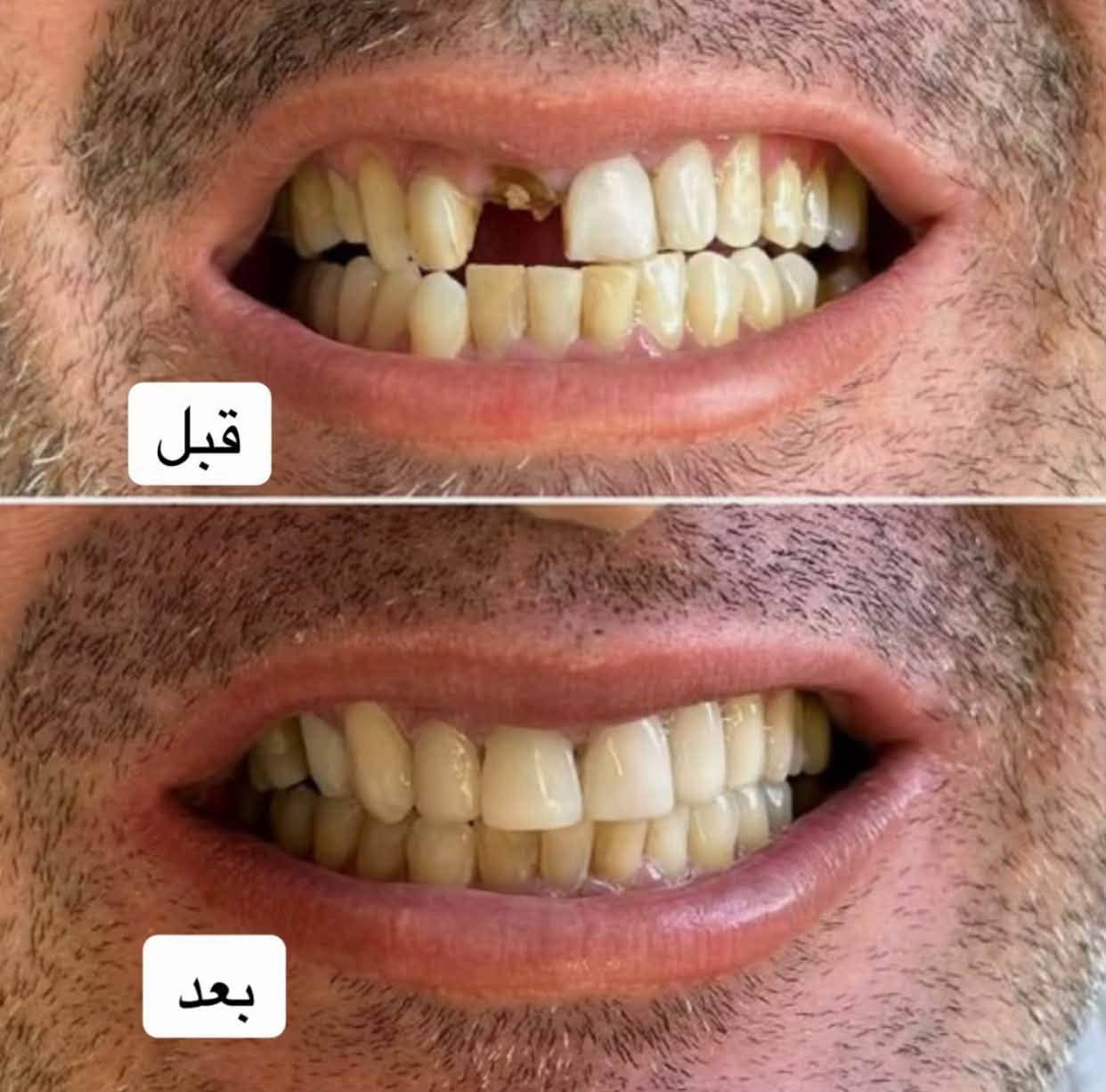 مجاني • عيادات جامعة الفارابي • حشوات/تبيض/قلع