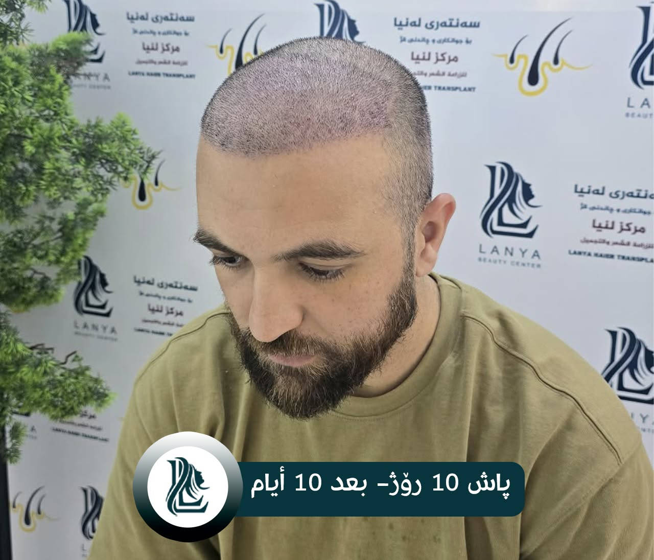 زراعة شعر • لەنیا • كلار