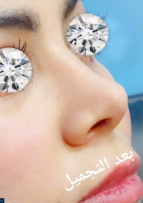 تجميل أنف • قبل وبعد • عيادة الياسري