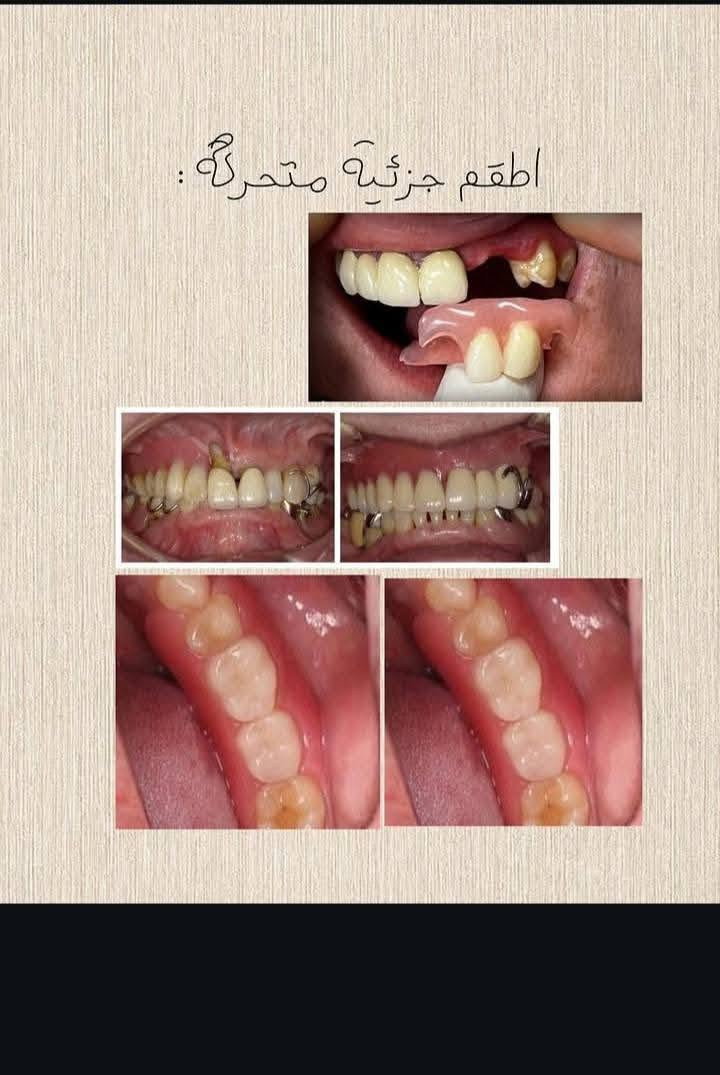 علاج مجاني • قلع الأسنان • علاج أسنان الأطفال