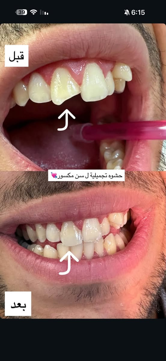 تنظيف اسنان • مجانا • جامعة الزهراوي