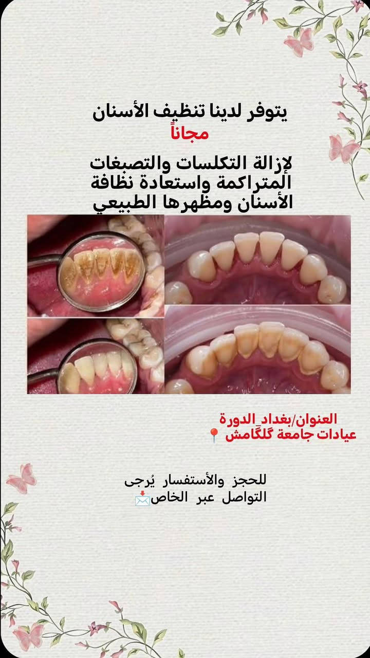 حشوات ضوئية • تنظيف أسنان • بغداد الدورة