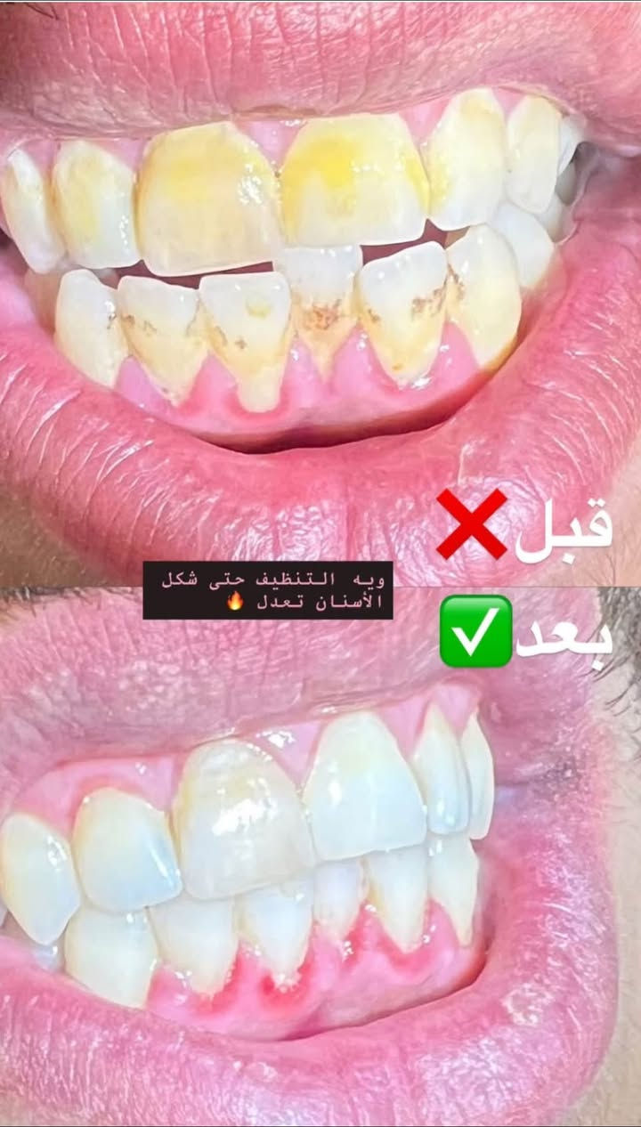 علاج أسنان • الرمادي داخل الكلية • اسعار رمزية
