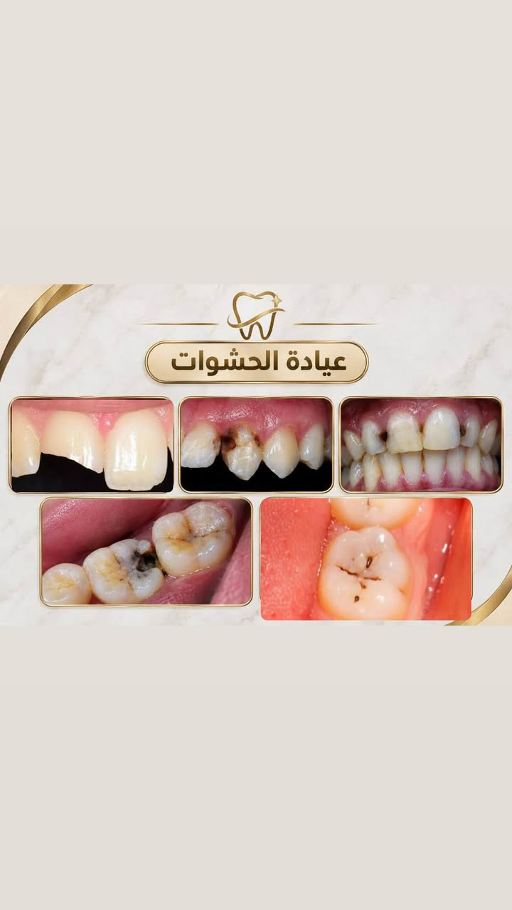 الـسلام عليكم
العلاج مجـاني  بالكامل 
متوفر قلع الاسنان التالفة وبقايا الجذور وتعويضها بطقم متحرك تنظيف حشوات ضوئية كلشي معقم ونظيف تحت اشراف اطباء مختصين

نص مكتوب في الصور:
- دكتورة زينب فرحان طالبة طب وجراحة الفم والأسنان الخدمات المتوفرة قلع الأسنان حشوات تجميلية تركيب طقم أسنان تنظيف الأسنان مكان العيادة كلية طب الأسنان جامعة دجلة *********** @bk__ares نعني بابتسامتك لأنك تستحق الأفضل
- عيادة تنظيف الاسنان
- عيادة القلع
- عيادة الحشوات
- عيادة ( طقم الاسنان الجزئي )