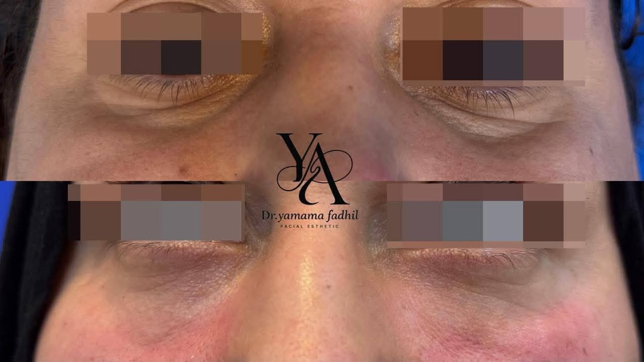 عيادة اليمامة 🕊
لأنكِ تستحقين الأفضل دائماً، تقدم لكِ الدكتورة [يمامة فاضل ] أحدث تقنيات التجميل والعناية بالبشرة للوصول إلى إطلالة ساحرة وطبيعية دون تغيير في ملامحكِ الأصيلة.

☀️تواجد دكتورة(السبت والاثنين والأربعاء) 
☀️العنوان (التصنيع مجاور صيدلية الذهب الاخظر )
☀️الحجز والاستفسار (***********) 
☀️معاينة مجانية
