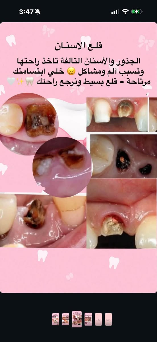 علاج جميع مشاكل الاسنان مجاناً
حشوات تجميليه /تنظيف/قلع الجذور التالفه/ تعويض الاسنان المفقوده/علاج اسنان الاطفال /تقويم 

📍📍بغداد الكراده  ٥٢ جامعة أوروك طب الأسنان مقابل مطعم نانار 

لتواصل خاص او واتساب +9647888597722

نص مكتوب في الصور:
- حشوات الأسنان تسوس بسيط اليوم.. ممكن يصير وجع بكرة تعالو نعالج التسوس وخلي ابتسامتك صحية كلية طب الاسنان جامعة اوروك
- بدون تخدير تنظيف الأسنان التكلسات تخلي ابتسامتك باهتة تنظيف الأسنان مو بس للمظهر، يحافظ على صحة اللثة ويخلي ابتسامتك تبرق تعال نخلي أسنانك مثل اللؤلؤ كلية طب الاسنان جامعة اوروك
- قلع الاسنان الجذور والأسنان التالفة تأخذ راحتها وتسبب ألم ومشاكل 😣 خلي ابتسامتك مرتاحة - قلع بسيط ونرجع راحتك 🦷🤍✨