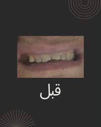 ابتسامة هوليود • عيادة الفهد • العبيدي بغداد
