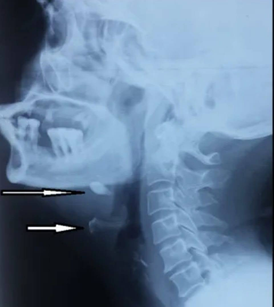 🩻 دور الأشعة الرقمية DR في تشخيص حصوات الغدد اللعابية
هل تعاني من ألم أو تورم في منطقة الفك أو تحت اللسان، خصوصًا أثناء تناول الطعام؟
قد تكون هذه الأعراض مرتبطة بوجود حصوات في الغدد اللعابية.
🔍 تساعد الأشعة الرقمية DR في الكشف عن بعض حصوات الغدد اللعابية، خصوصًا الحصوات التي تحتوي على نسبة عالية من الكالسيوم وتظهر بوضوح في صورة الأشعة.
📌 أهم الأعراض التي تستدعي الفحص:
• تورم متكرر في الغدة اللعابية. 
• ألم يزداد أثناء تناول الطعام. 
• جفاف الفم أو صعوبة في إفراز اللعاب. 
• ألم أو انتفاخ أسفل الفك أو تحت اللسان. 
✨ التصوير بالأشعة الرقمية يتميز بـ:
✅ سرعة إجراء الفحص. 
✅ وضوح ودقة الصورة. 
✅ إمكانية المساعدة في تحديد موقع الحصوة. 
✅ دعم الطبيب في اختيار الإجراء التشخيصي أو العلاجي المناسب. 
📍 عيادة العامل للأشعة الرقمية DR
دقة في التصوير… وسرعة في النتائج… وثقة في التشخيص.
🩻 إذا كنت تعاني من أعراض متكررة، فالفحص المناسب يساعد في الوصول إلى التشخيص الصحيح.
صحتكم.. اهتمامنا
متواجدين طيلة ايام الاسبوع مع يوم الجمعة من الساعة(4-8) مساءً بوجود كادر نسائي متمرس والعيادة طابق ارضي
حي العامل.. السوق الشعبي.. شارع الأطباء.. مجاور صياغة الزيدي.. مقابل مكتب السيد الشهيد محمد صادق الصدر (قدس سره) 
للاستفسار الاتصال على الرقم :***********
