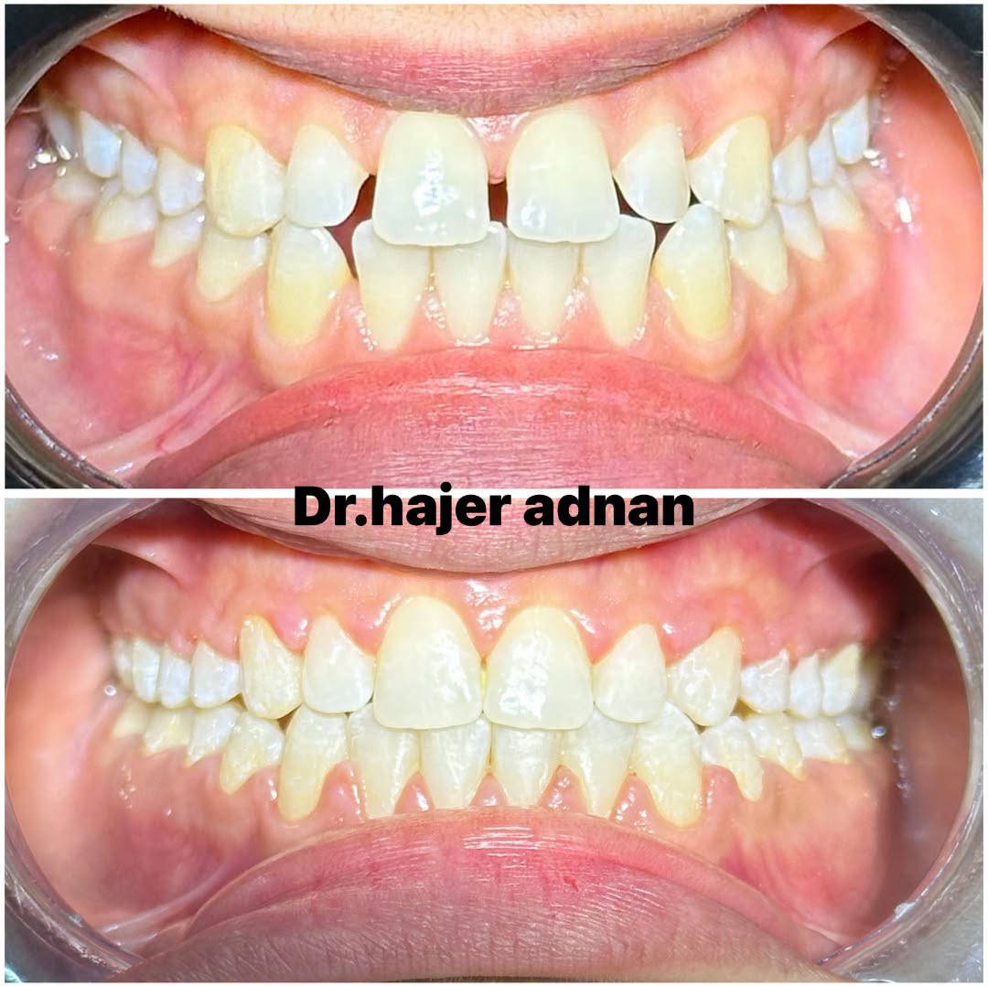 “من فراغات واضحة إلى ابتسامة متناسقة ✨🦷
بعد إكمال علاج التقويم تم إغلاق الفراغات وتحقيق اصطفاف أفضل للأسنان، لتكون النتيجة ابتسامة طبيعية وأكثر جمالًا. 🤍 
الدكتورة هاجر عدنان

نص مكتوب في الصور:
- Dr.hajer adnan