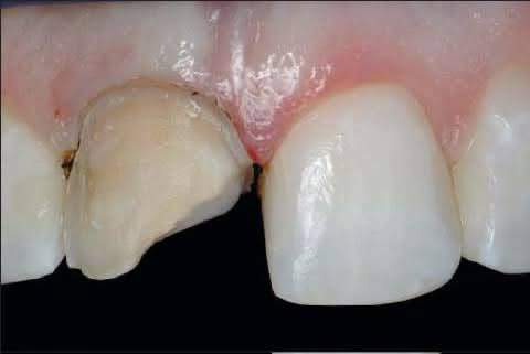 عندك هيج أسنان مكسورة؟؟؟
علاجها مجاناً بحشوات ضوئية احترافية .
📍عيادات جامعة كربلاء- حي الموظفين
للتواصل / ***********
