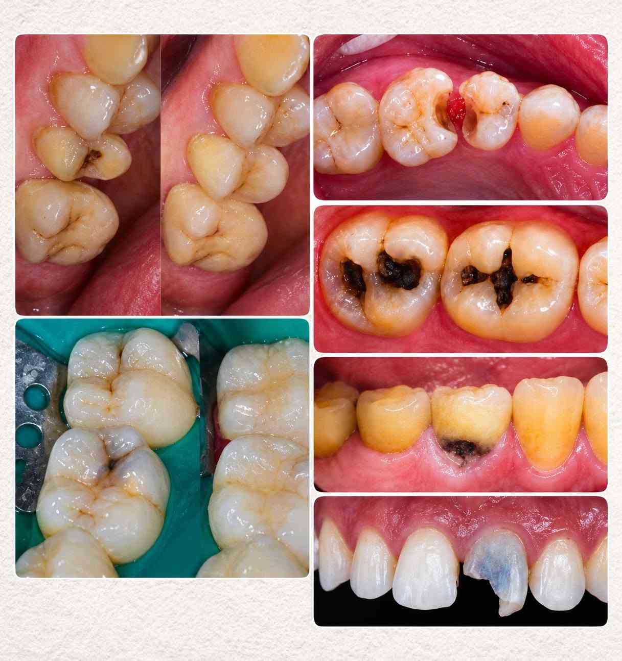 🦷✨ تم فتح باب الحجز لعلاج الأسنان المجاني ✨🦷
📍في عيادات جامعة أصول العلم 

الحالات المتوفرة 👇👇 
📍 حشوات ضوئية – قلع – تنظيف تكلسات  – طقم أسنان متحرك.

✅ كلشي متوفر وبالمجان وتحت إشراف أطباء اختصاص 

الموقع :- بغداد _ كلية أصول العلم _ باب المعظم _ قرب معهد الادارة

📞 للحجز والاستفسار
التواصل على الخاص أو واتساب: ***********
