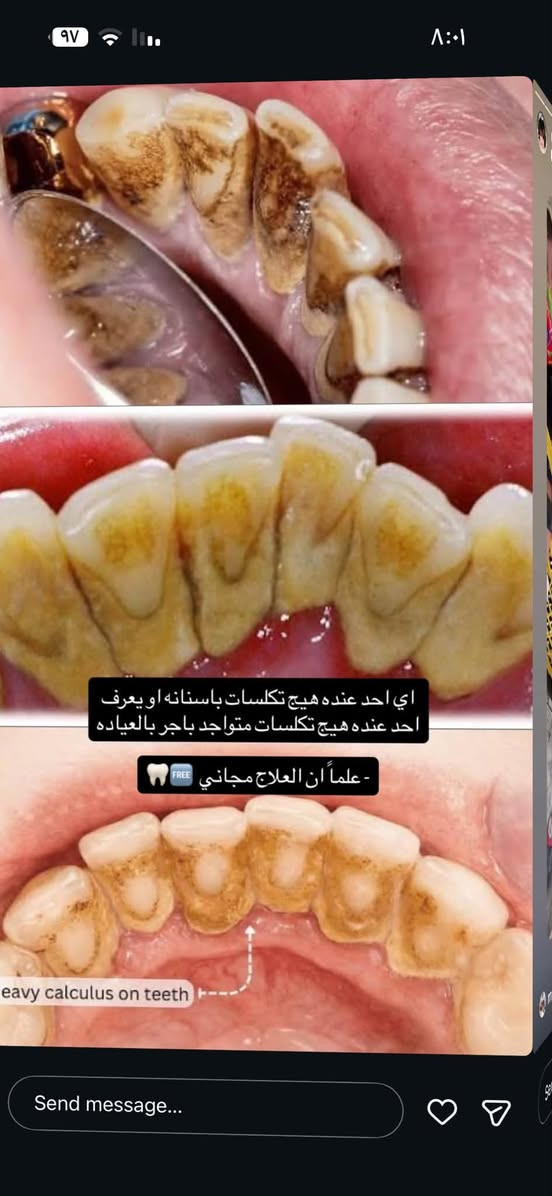 تكلسات أسنان • علاج مجاني • اليرموك الأربع شوارع