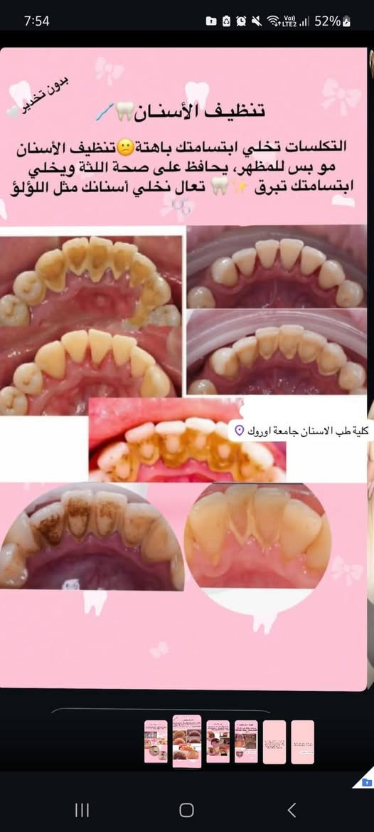 تنظيف الأسنان • إزالة التكلسات • جامعة اوروك