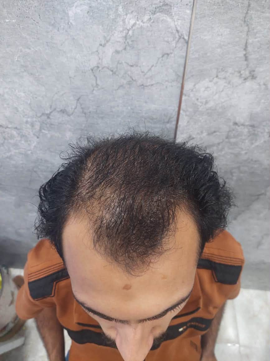 عيادة استيرا • زراعة شعر • الرمادي الانبار