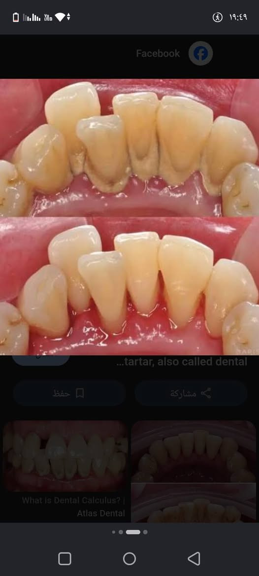 🦷 عندك حالة أسنان وتدور على علاج بسعر رمزي؟
لفترة محدودة أستقبل حالات للعمل عليها في عيادات جامعة النور التخصصية لطب الأسنان 🤍
الحالات المتوفرة حاليًا:
🦷 قلع الأسنان — 3,000 د.ع
تنظيف الأسنان — 4,000 د.ع
🦷 حشوات ضوئية — 5,000 د.ع

وعندي أيضًا حالات أطفال:
• قلع — 2,000 د.ع
• حشوة — 5,000 د.ع
• فلورايد — 2,000 د.ع
 وحالات التعويضات:
• طقم متحرك كامل لفقدان جميع الأسنان
•
أسعار الأطقم تُحدد حسب الحالة ونوع التعويض.
جميع الحالات تتم داخل العيادات التعليمية وتحت إشراف الأطباء.
📩 إذا عندك حالة أو أحد من أهلك يحتاج علاج، دزولي صورة للحالة بالخاص وأوضح لكم إذا الحالة مناسبة والتفاصيل كاملة.
🤍 واللي يعرف شخص محتاج إحدى الحالات، ياريت يدزله المنشور.
📍 جامعة النور – عيادات طب الأسنان

نص مكتوب في الصور:
- فقدان جميع الاسنان نعوضه بطقم متحرك
- Facebook ...tartar, also called dental حفظ مشاركة What is Dental Calculus? | Atlas Dental
- نقوم بإزالة التسوس ونستخدم حشوة ضوئية
- يحتاج إزالة التكلسات وتنظيف