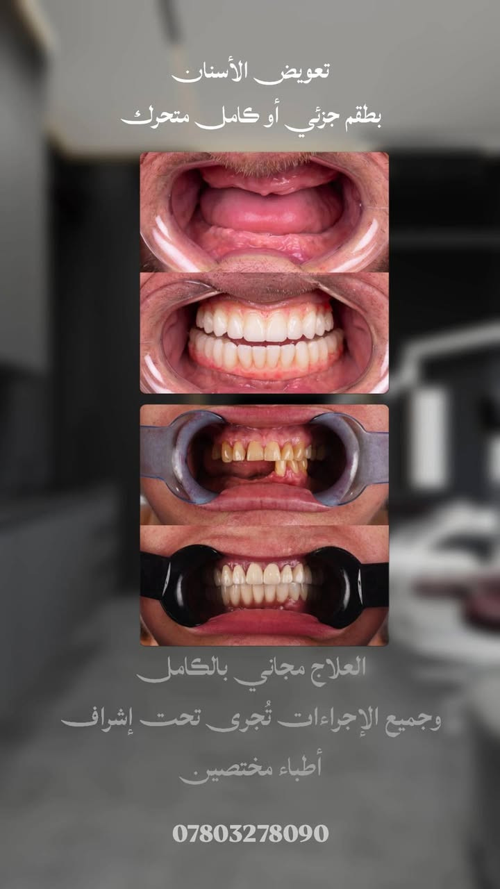 عـلاج الأسنان بالمجـان 
اي شخص يحتاج حشوات تجميلية دائمية 
قلع الأسنان والجذور التالفة
تنظيف اسنان وازالة التكلسات 
تعويض الأسنان المفقودة بطقم جزئي 

يتواصل ويانه ***********
العـلاج يكون مجـانـي بالكـامل وتحت إشـراف أطبـاء مختـصين 

العنوان / ناصرية - شارع النيل - بحي الشهداء - جامعة العين - مستشفى العين لطب الأسنان

نص مكتوب في الصور:
- تنظيف الأسنان وأزالة التكلسات والتصبغات العلاج مجاني بالكامل وجميع الإجراءات تُجرى تحت إشراف أطباء مختصين ***********
- قلع الأسنان والجذور الغير قابلة للعلاج العلاج مجاني بالكامل وجميع الإجراءات تُجرى تحت إشراف أطباء مختصين ***********
- أزالة التسوس وترميم الأسنان بالحشوات التجميلية العلاج مجاني بالكامل وجميع الإجراءات تُجرى تحت إشراف أطباء مختصين ***********
- تعويض الأسنان بطقم جزئي أو كامل متحرك العلاج مجاني بالكامل وجميع الإجراءات تُجرى تحت إشراف أطباء مختصين ***********