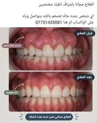جامعة كربلاء • علاج مجاني • تضخم اللثة
