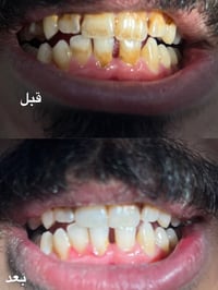 قلع مجاني • حشوات • عيادات جامعة البيان