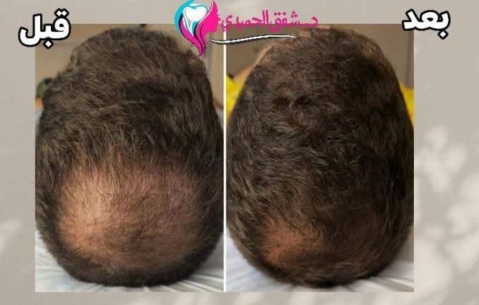 في عيادة البدر لطب وزراعة وتقويم الأسنان  
 نقدم لكم خدمات متكاملة بأحدث التقنيات وعلى أيدي أطباء مختصين، حتى تحصلون على ابتسامة أجمل وإطلالة أكثر إشراقًا بثقة وراحة.

🦷 خدمات الأسنان:  "الدكتور مصطفى محمد البدر "
• زراعة الأسنان
• تقويم الأسنان (تقليدي وشفاف)
• تجميل الابتسامة (فينير وابتسامة هوليود)
• علاج العصب والحشوات
• تبييض الأسنان بالليزر

💉 خدمات التجميل:  الدكتورة د.شفق شلال "

• بوتوكس
• فيلر
• توريد الشفايف
• إبرة النضارة
• بلازما للشعر
• ميزوثيرابي
• علاج الكلف والتصبغات 

    🕧متواجدين يوميا  من الساعة 4 إلى الساعة 8
    
📍 العنوان: البدير - مجمع دعاء شاكر البديري
📞 للحجز والاستفسار: ***********
ننتظركم في عيادة البدر... لأن اهتمامنا بتفاصيل ابتسامتكم وجمالكم يبدأ من أول زيارة. ✨

#زراعة_الأسنان #تقويم_الأسنان #ابتسامة_هوليود #تبييض_الأسنان  #بلازما_للشعر #البدير #الديوانية
