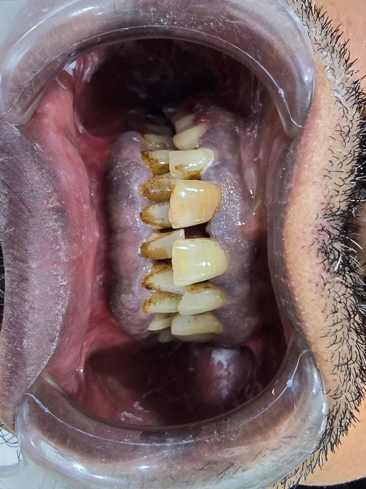 قبل تركيب ابتسامه ايماكس
واثناء العمل
وبعد تركيب الابتسامه
باشرف الطبيب ثائر عباس

📍 متواجدين يومياً طوال أيام الأسبوع:

⏰ من 9 الصبح إلى 12 الظهر
⏰ ومن 2:30 العصر إلى 9:30 بالليل

📞 للتواصل ويانه:

✅ العيادات البشرية: ***********
✅ عيادات التجميل: ***********
✅ عيادات الأسنان: ***********

📍 العنوان:
الناصرية – شارع بغداد، مجاور مدرسة الجواهري الأهلية

#العراق #تجميل #اكسبلور #ترند #explore
