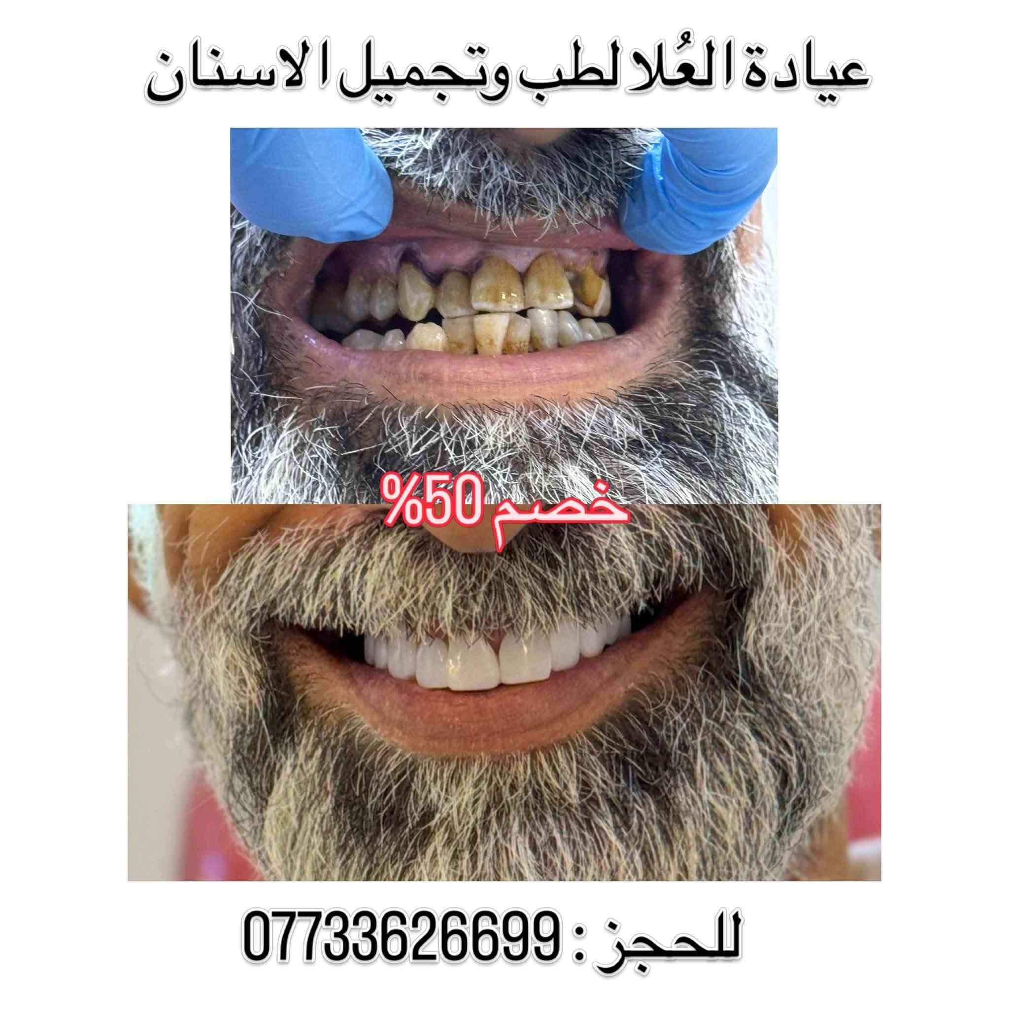 خصم ٥٠٪ • ابتسامة هوليوود • الشرطة الخامسة