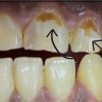 تسوسات اسنان • علاج مجاني • جامعة ابن سينا