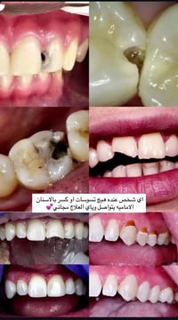 علاج مجاني • تسوسات • أسنان أمامية