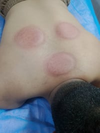 حجامه اهل البيت • شفاء الجرح مباشر • كؤوس مرة وحدة