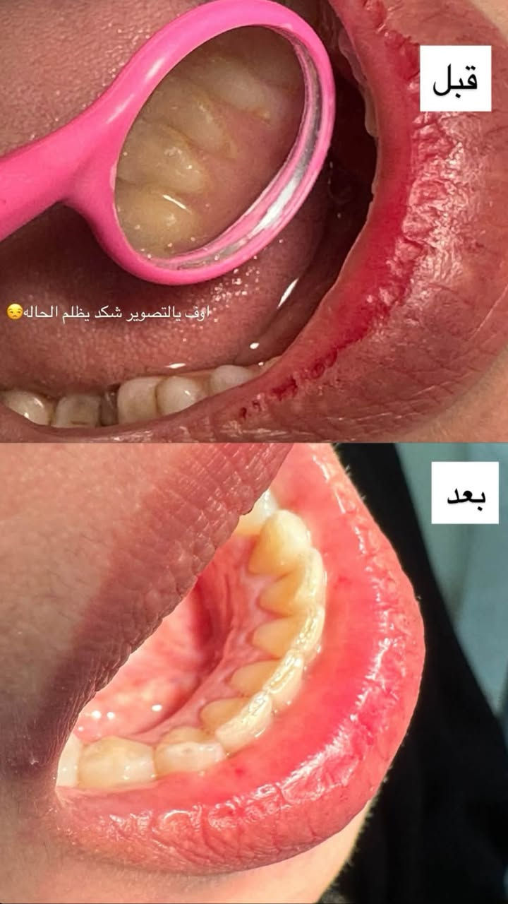 تنظيف اسنان • مجانا • جامعة الزهراوي