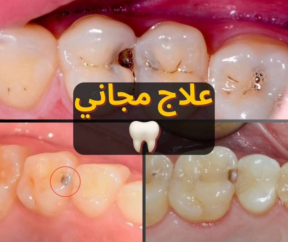 علاج مجاني • تسوس الاسنان • جامعة الكوفة