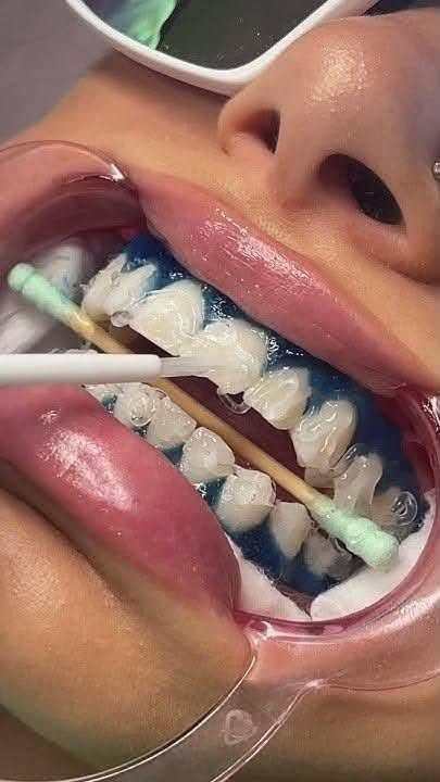 🦷✨ تعلن عيادة الزين لطب الأسنان ✨🦷
🎉 أسبوع تبييض الأسنان المجاني 🎉
لا تفوّتوا الفرصة! 😍
باشروا بالحجز من هسه 📲

📍 العنوان: داخل مجمع بسماية السكني
🏢 بناية دار المعرفة – عمارة مطعم سندريلا

📞 للحجز والاستفسار:
***********

🔥 وعروض جديدة ومميزة بانتظاركم!
⏰ انتظروها اليوم العصر… تنزل قريباً 👀✨

🦷 عيادة الزين لطب الأسنان — ابتسامتك تهمنا 🤍 عياده الزين للاسنان الاسنان
