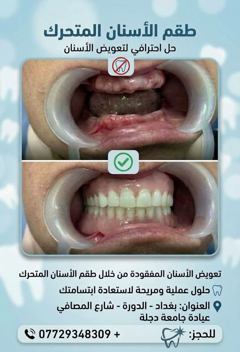 🦷 ابتسامتك وصحة أسنان عائلتك بأيدٍ أمينة… ومجاناً بالكامل ...

تحت إشراف نخبة من الأطباء والأخصائيين، يعلن فريق  طبي متخصص  من الكوادر النسائية في جامعة دجلة عن استقبال الحالات المرضية لتوفير الفحص والعلاج مجاناً بالكامل (100%) دون تحمل أي أجور للكشفية أو المواد أو العمل العلاجي.

✨ علاج مجاني بالكامل | أجهزة حديثة | إشراف طبي متخصص | عناية وتعقيم بأعلى المستويات

ويتم تقديم العلاج تحت إشراف مباشر من طبيبات أخصائيات، حرصاً على الدقة وجودة العمل وسلامة المراجعين.

👧 عيادة الأطفال | من عمر 4 إلى 11 سنة

تشمل الخدمات:
• علاج تسوس الأسنان وحشوات الأسنان اللبنية.
• قلع الأسنان التالفة أو المتحركة بعناية وحرص.
• تنظيف الأسنان.
• سد الفجوات للمساعدة في حماية أسنان الطفل من التسوس.

👩 عيادة النساء | جميع الأعمار

تشمل الخدمات:
• الحشوات التجميلية والحشوات الاعتيادية.
• تنظيف الأسنان وإزالة التكلسات والتصبغات.
• تعويض الأسنان المفقودة من خلال أطقم الأسنان والجسور.

👴 عيادة كبار السن | من عمر 60 سنة فما فوق

• صناعة وتعويض أطقم الأسنان الكاملة والجزئية للفك العلوي والسفلي.
• المساعدة على استعادة القدرة على المضغ وتحسين وظيفة وشكل الأسنان.

📍 الموقع:
بغداد – الدورة – شارع المصافي – جامعة دجلة الأهلية

💰 التكلفة:
مجــانــاً 100%
دون أي رسوم للكشفية أو المواد أو العمل العلاجي.

🩺 خصوصيتك وسلامتك أولويتنا
كادر طبي نسائي، مع الالتزام بأعلى معايير التعقيم والعناية أثناء تقديم الخدمات العلاجية.

📩 للحجز والاستفسار:
يرجى إرسال رسالة خاصة لغرض الفرز وتحديد الأولوية، أو التواصل عبر الواتساب:
📞  ***********

✨ لا تؤجل علاج أسنانك… ولا تحرم طفلك من ابتسامة صحية.
احجز الآن واستفد من العلاج المجاني بالكامل في العيادات التعليمية بجامعة دجلة الأهلية.

نص مكتوب في الصور:
- عناية بابتسامات أطفالنا
- صحة أسنان طفلك، أمان وثقة.
- وكل مشاكل اسنان الاطفال 💙
- بغداد/الدورة/ شارع المصافي/جامعه دجلة 📍
- للحجز والاستفسار: 📷 📞 ***********
- جامعة دجلة Digla University Dental Clinic مركز طب الأسنان التابع لجامعة دجلة - خدمات علاجية شاملة تسوس الأضراس الخلفية كسر في الأسنان الأمامية تراجع اللثة وتآكل الأسنان كسر في السن السفلي • العلاج المجاني تحت إشراف أخصائيين برعاية كلية طب الأسنان - جامعة دجلة • الموقع حي الدورة, بغداد, العراق - مبنى جامعة دجلة www.diglauniversity info@digladeals.com 024-973727
- عيادة تنظيف الاسنان
- ازالة التكلسات والتصبغات
- العلاج مجانًا تحت إشراف اطباء مختصين
- الموقع: الدورة _جامعة دجلة
- طقم الأسنان المتحرك
- حل احترافي لتعويض الأسنان
- تعويض الأسنان المفقودة من خلال طقم الأسنان المتحرك
- حلول عملية ومريحة لاستعادة ابتسامتك
- العنوان: بغداد - الدورة - شارع المصافي
- عيادة جامعة دجلة
- للحجز: + ***********
- الخطة العلاجية المقترحة العلاج مجاناً تحت اشراف اطباء مختصين قلع الاسنان التالفة وبقايا جذور الدورة_جامعة دجلة للتواصل والحجز: *********** @generic جامعة دجلة Al-Dajla University